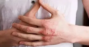 Egzamayı tetikliyor! Sakın bu hataları yapmayın...