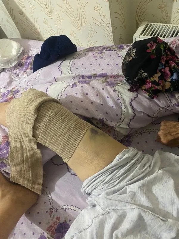 Ankara'da bakıcı dehşeti! 91 yaşındaki kadının başından aşağı sıcak yemek  döktü | Hastanede ölüm kalım