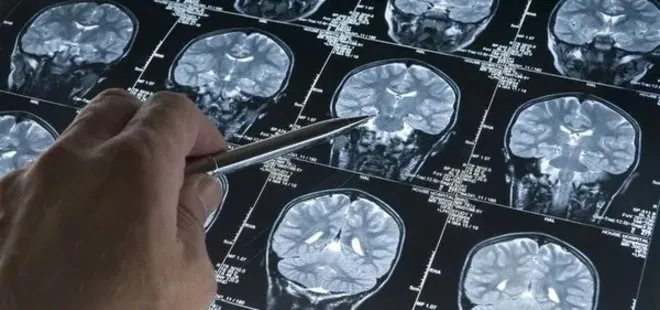 Yeni araştırma: Alzheimer’ı yıllar önceden tespit edecek!