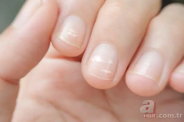 Tırnak diplerinizi kontrol edin! Belki de bu hastalıklardan birine sahipsiniz... 3