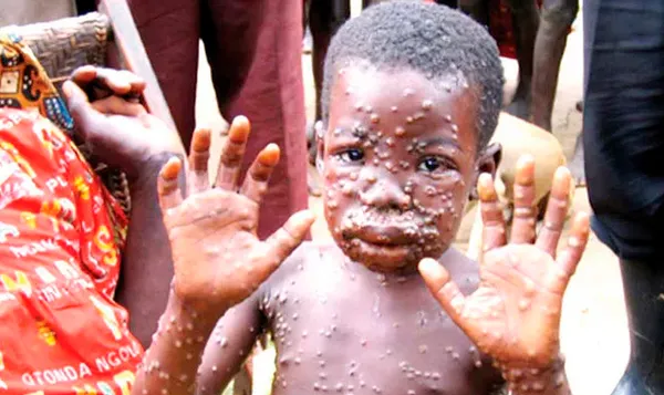 Maymun çiçeği virüsünün belirtileri nelerdir? Ölüm riski düşük ama çok acı çektiriyor | Maymun çiçeğinin iyileşme süreci ne kadar?