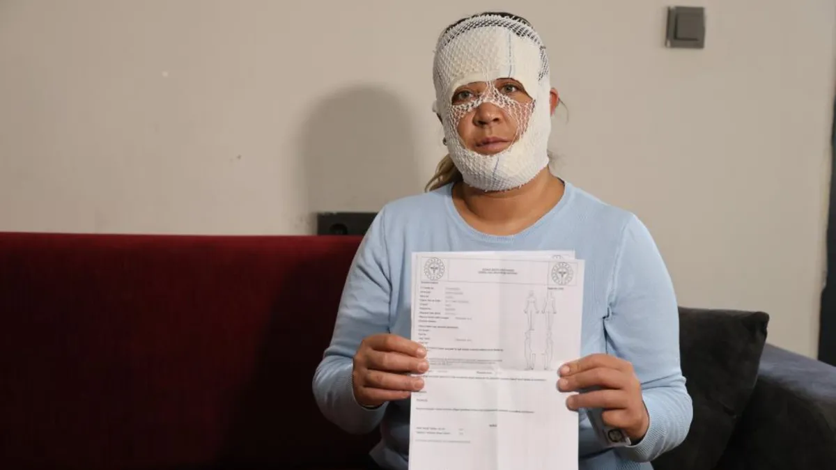 Güzelleşmek uğruna gittiği merkezde yüzü yandı: "2 yaşındaki oğlum benden korkuyor"