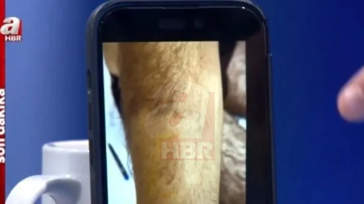 Narin Güran cinayetinde düğüm çözülüyor! Enes Güran'ın kolundaki ısırık izi ve yüzündeki morluk ilk kez A Haber'de