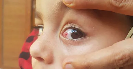 Deniz ve havuzda serinlemek isteyen tatilcilere 'kırmızı göz hastalığı' uyarısı - 1