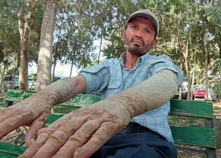 26 yıldır sedef hastalığıyla mücadele ediyor! Görenlerin kaçmasına alışamadı