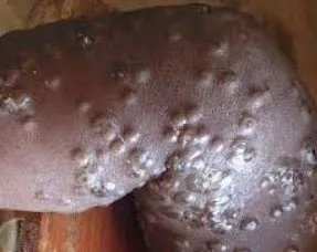 Maymun çiçeği virüsü nedir? Türkiye’de görüldü mü? Maymun çiçeği hastalığı nasıl bulaşır, belirtileri neler?