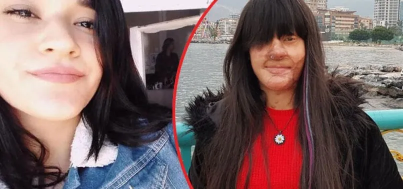 Son dakika: Berfin Özek davasında flaş gelişme! Yüzüne asit döken Rasim Ozan Çeltik hakkındaki şikayetinden vazgeçti