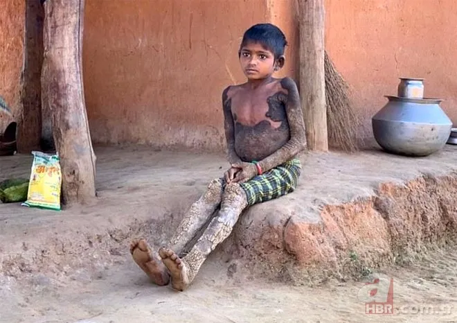 Vücudu her geçen gün taşa dönüşüyor! 4