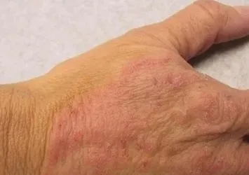 Sıcak ve nem mantar vakalarını artırıyor