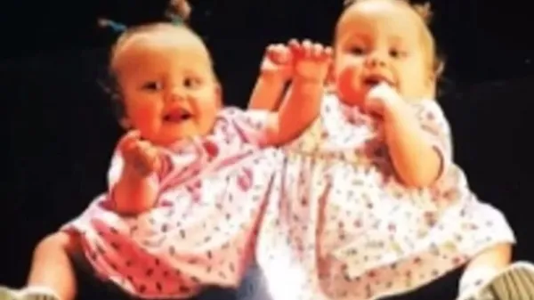 Kaybettiği yapışık ikizinin hayalini gerçekleştirdi! Hikayeleri Yürek bukrtu