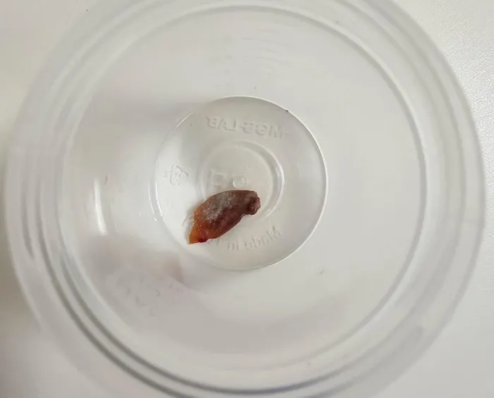 1758609549030.jpeg Geçmeyen öksürüğe neden olduğu belirlenen kabak çekirdeği başarılı bir operasyonla alındı. (İHA)