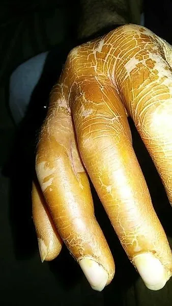 eline-batan-kurdan-canindan-ediyordu-doktorlar-bile-sasirdi-1615438509740.jpg Eline batan kürdan canından ediyordu! Doktorlar bile şaşırdı! - 3