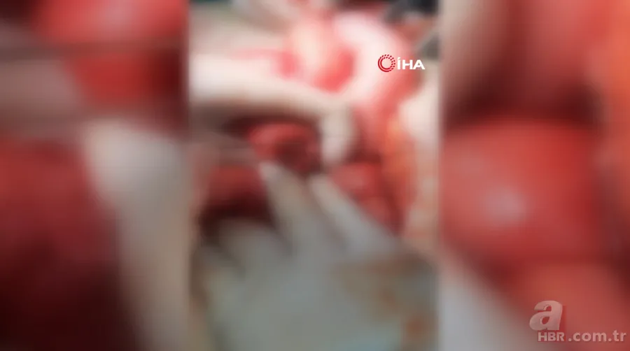 Amasya’da 22 yaşındaki genç kız karın ağrısı şikayetiyle hastaneye gitti! Gerçek şoke etti: Tam 5 kilo 16