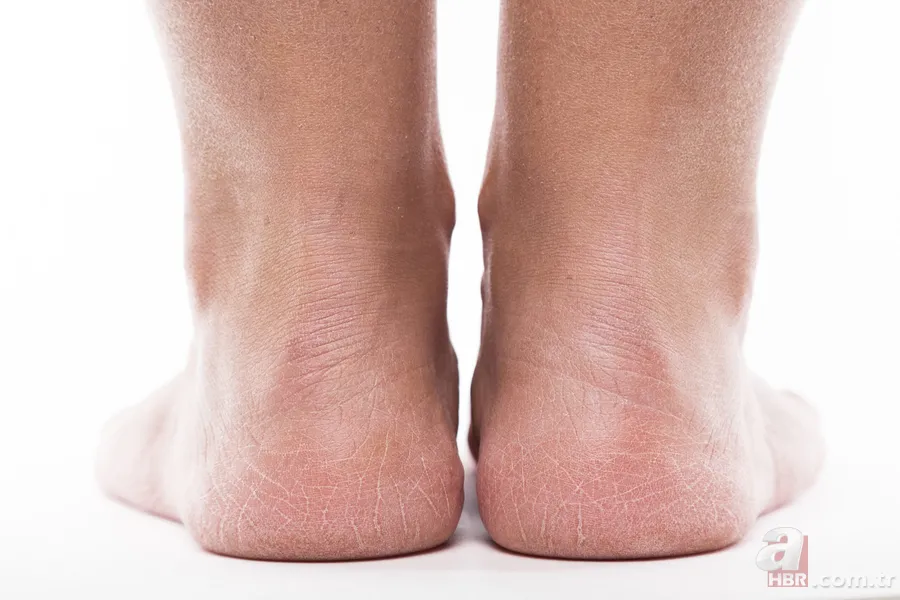 Topuklarınızdaki çatlakları geçirecek yöntem! Bir haftada 1-2 kere yapmanız yeterli: Lokum gibi olacak! 4