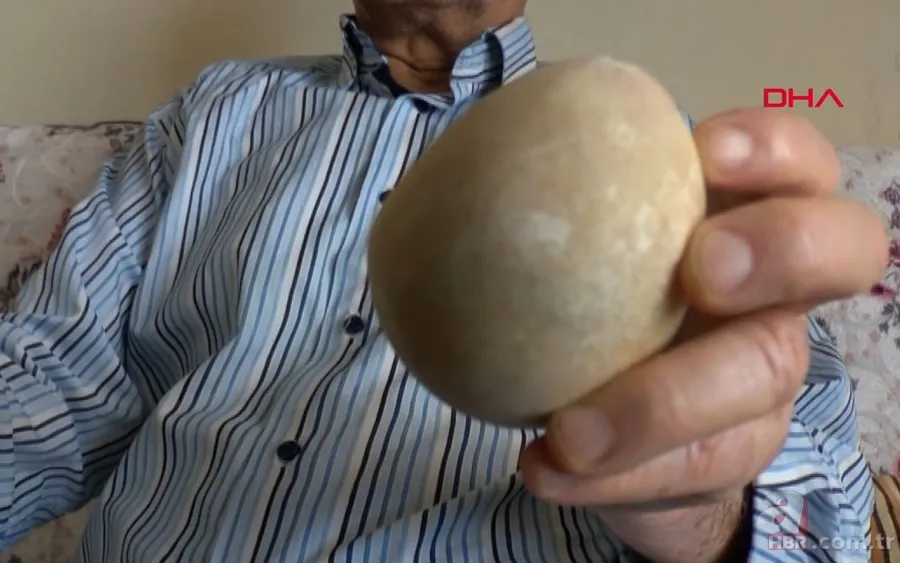 Karın bölgesinde şişlik ve halsizlik şikayetiyle doktora gitti! Karnından çıkanlar şoke etti 17