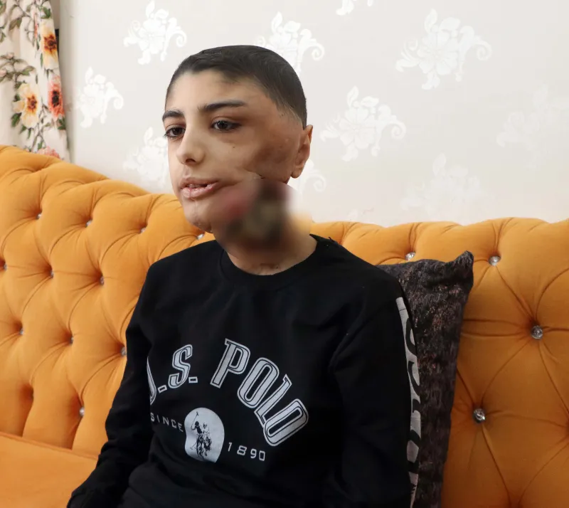 Çenesinin altına kadar indi! Yüzündeki yara her geçen gün büyüyor