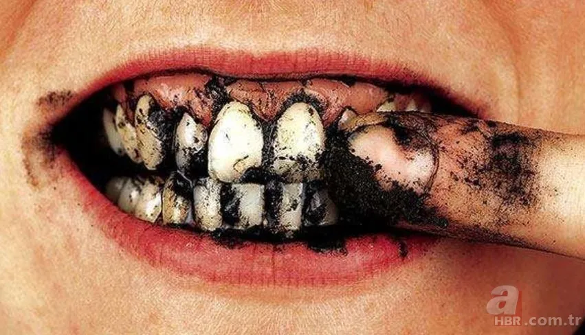 Diş beyazlatma yöntemleri işe yarıyor mu? 1