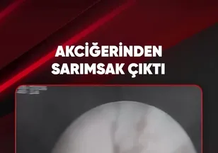 AKCİĞERİNDEN SARIMSAK ÇIKTI