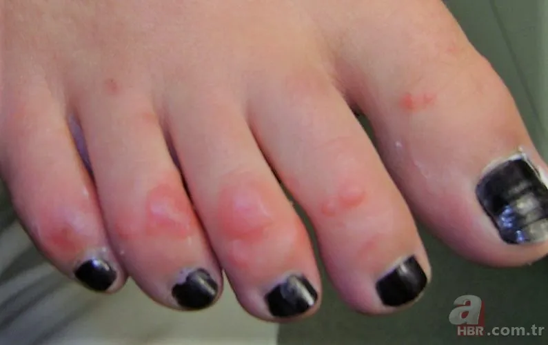 Chilblains ne demek? Chilblains hastalığı belirtileri neler? Galatarasaylı Seri'nin hastalığı Chilblains nedir? 4