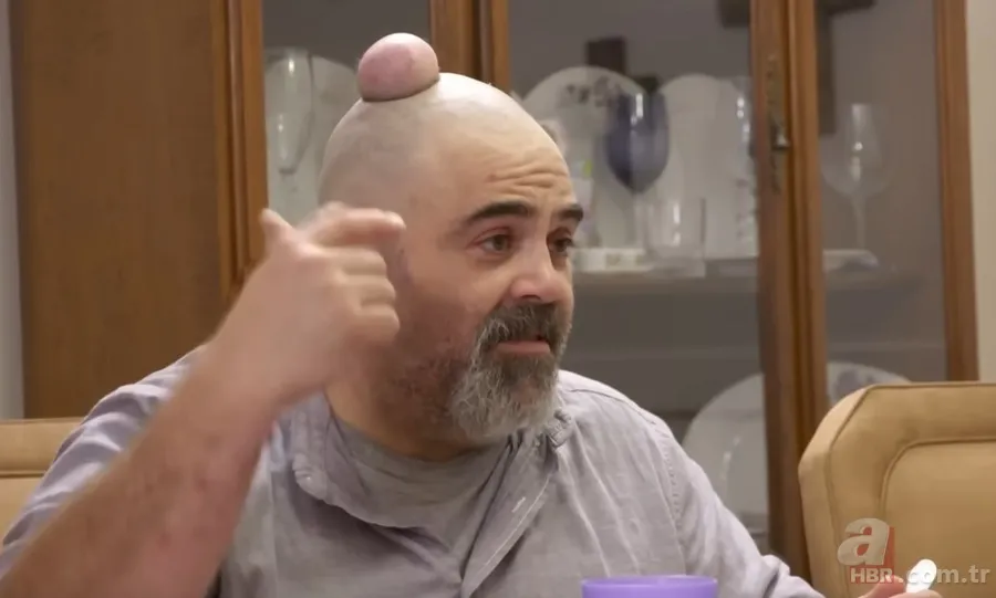 Sokağa şapka ile çıkıyordu! Başındaki şişlikten bakın ne çıktı 👩⚕️ Görenleri şaşkına çeviren olay 23