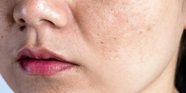 Sağlık Bakanlığından cilt kanseri uyarısı: 2-3 saatte bir tekrarlayın