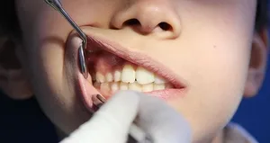 Şekerden sonra tüketince çürümeyi önlüyor...