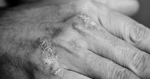 Stres bakın deriyi ne hale sokuyor!