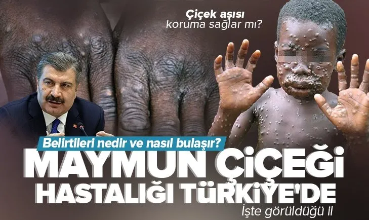 Son dakika: Maymun çiçeği hastalığı Türkiye’de! Sağlık Bakanı Fahrettin Koca duyurdu | Maymun Çiçeği hastalığı hangi ilde görüldü