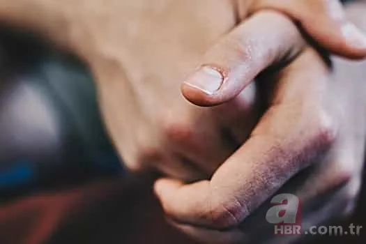 Chilblains ne demek? Chilblains hastalığı belirtileri neler? Galatarasaylı Seri'nin hastalığı Chilblains nedir? 7