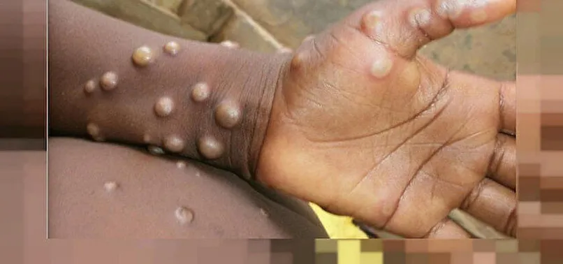 Birleşik Arap Emirlikleri'nde ilk maymun çiçeği vakası görüldü