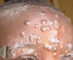 Maymun çiçek virüsü yeni salgına davetiye çıkardı! Avrupa’da vaka sayısı artışta, tedavisi yok 6