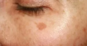 Güneş lekeleri nasıl geçer?