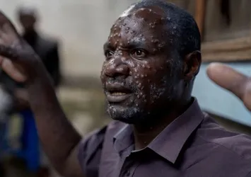 Afrika Birliği'nden M çiçeği salgını açıklaması: Afrika'nın değil tüm dünyanın sorunu