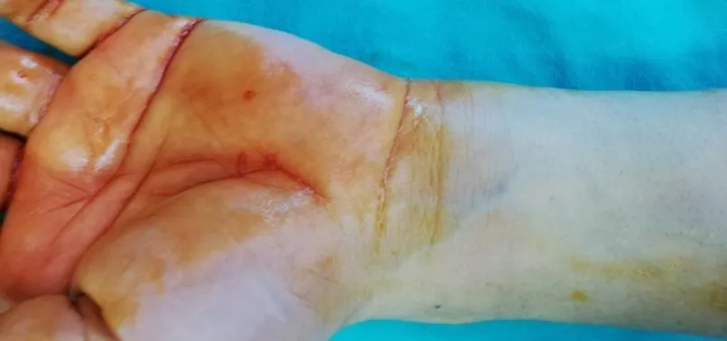 Dünyada çok nadir görülüyor! 'Kist hidatik' ameliyatı Diyarbakır'da yapıldı | 'Kist hidatik' nedir?