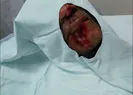 Öfkeli damat kayınpederinin dudağını kopardı