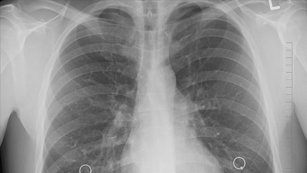 Akciğer kanserinde cerrahi yöntem hayat kurtarıyor