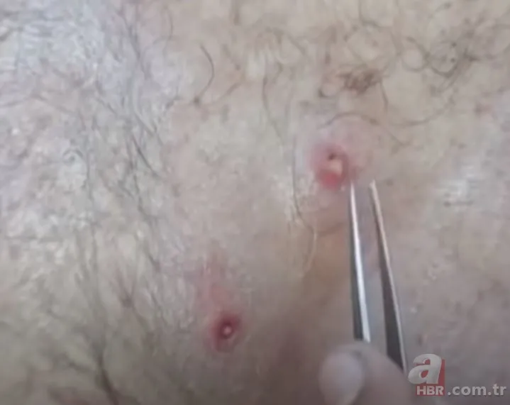 Sırtındaki yarayı sivilce zannetti ama gerçek dehşete düşürdü! Bakın içinden ne çıktı 21