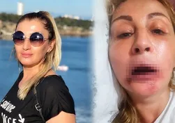 Dudağı çürüdü! İşte hatalı işlemin bedeli