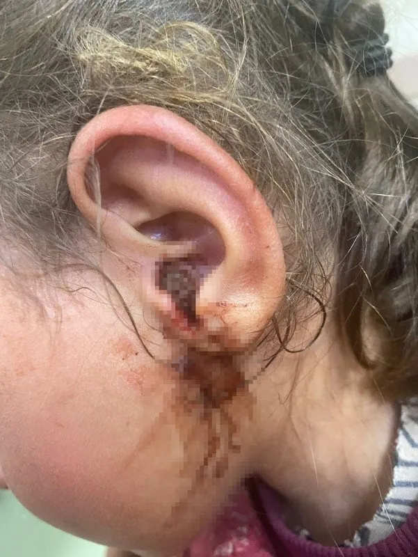 3 yaşındaki kızın kulağından bakın ne çıktı! Doktor mikroskopla kontrol edip hemen operasyona başladı