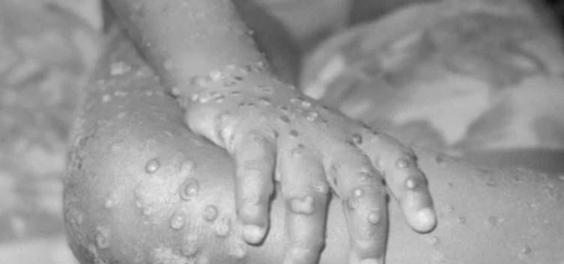 Bir ülkeye daha sıçradı! Slovenya’da ilk maymun çiçeği vakası