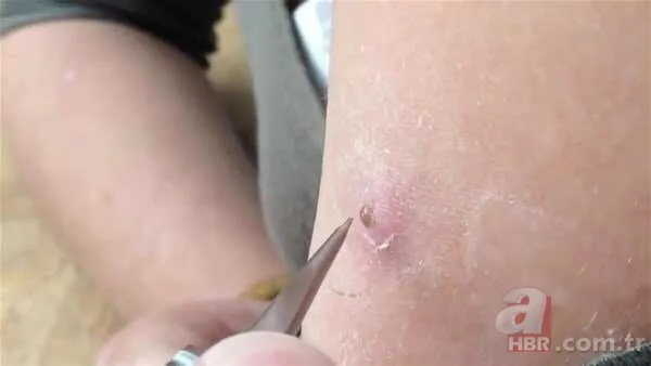 Genç kadının kolundan çıkanlar şoke etti 1