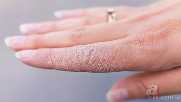 Egzamanın kökünü kurutan doğal ilaç tarifi! 4