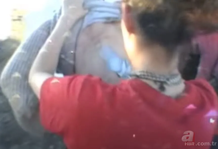 Sırtındaki yarayı sivilce zannetti ama gerçek dehşete düşürdü! Bakın içinden ne çıktı 4