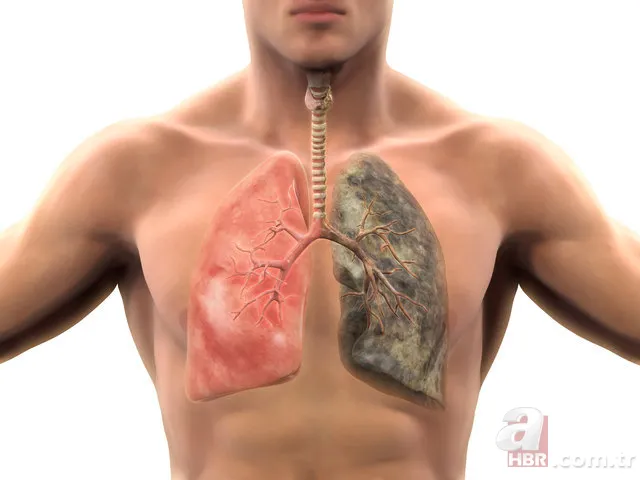 Akciğer kanseri belirtileri nelerdir? 13