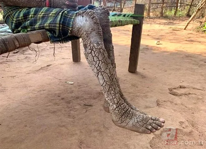 Vücudu her geçen gün taşa dönüşüyor! 6