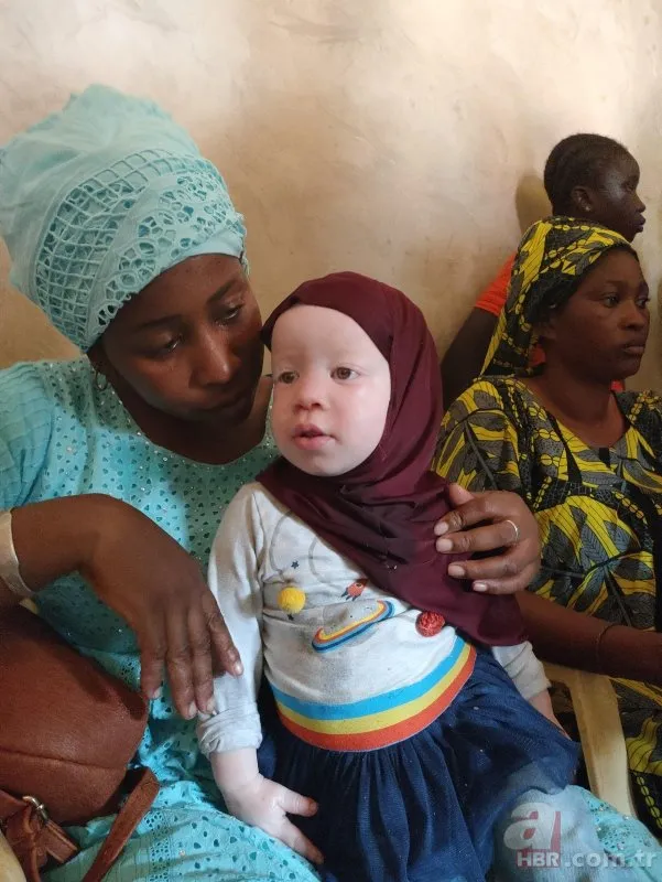THY güneşten saklanan albino hastası çocuklara ilaç oldu