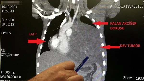 1699190527427.jpeg Röntgeni görünce doktorlar bile şaşkına döndü! Kalbi 12 santim kaydı, içinden kilolarca... - 2