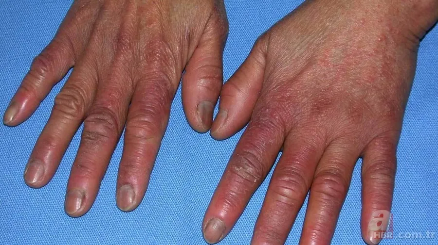 Chilblains ne demek? Chilblains hastalığı belirtileri neler? Galatarasaylı Seri'nin hastalığı Chilblains nedir? 2