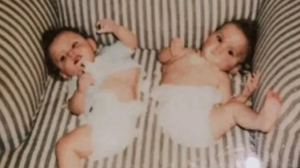 Kaybettiği yapışık ikizinin hayalini gerçekleştirdi! Hikayeleri Yürek bukrtu