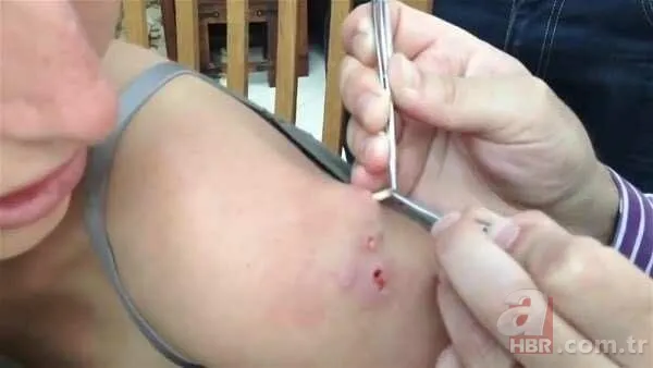 Genç kadının kolundan çıkanlar şoke etti 24